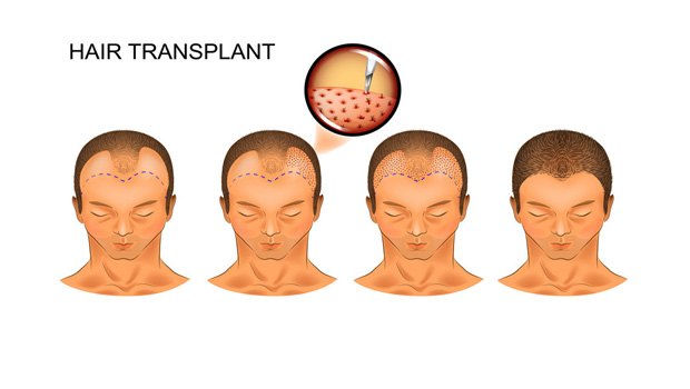 Hair transplantation - Maryam Hospital