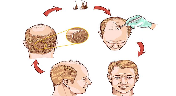 HAIR-TRANSPLANTATION