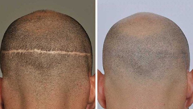 HAIR-TRANSPLANTATION