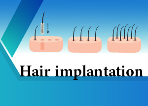 Hair Implantation