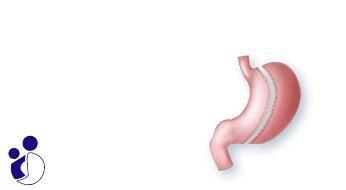 Gastric Sleeve Surgery in Iran