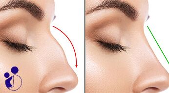 Rhinoplasty in iran