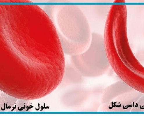 کمخونی داسی شکل در بارداری