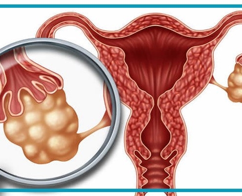 تخمدانهای پر کیست