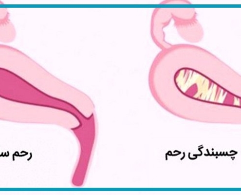 چسبندگی رحم