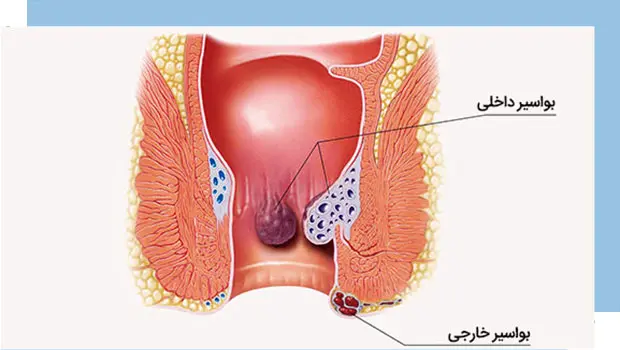 بواسیر یا هموروئید داخلی یا خارجی