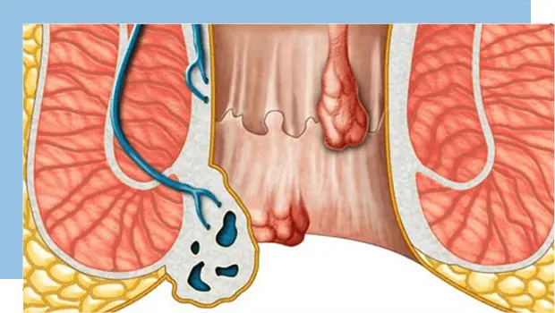 بواسیر یا هموروئید