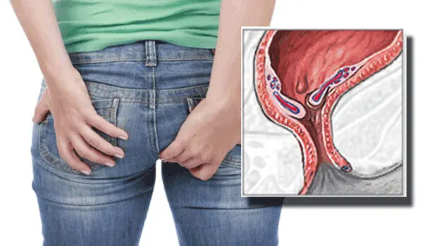 دلیل هموروئید