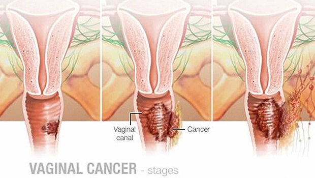علائم سرطان واژن
