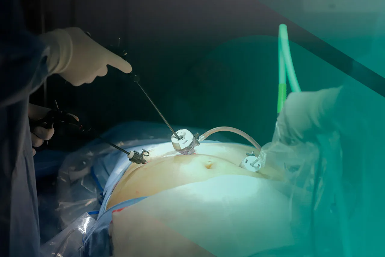 gastric sleeve 1