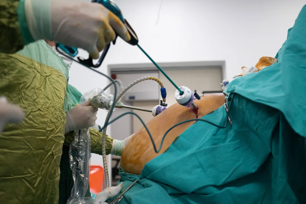 gastric sleeve 2