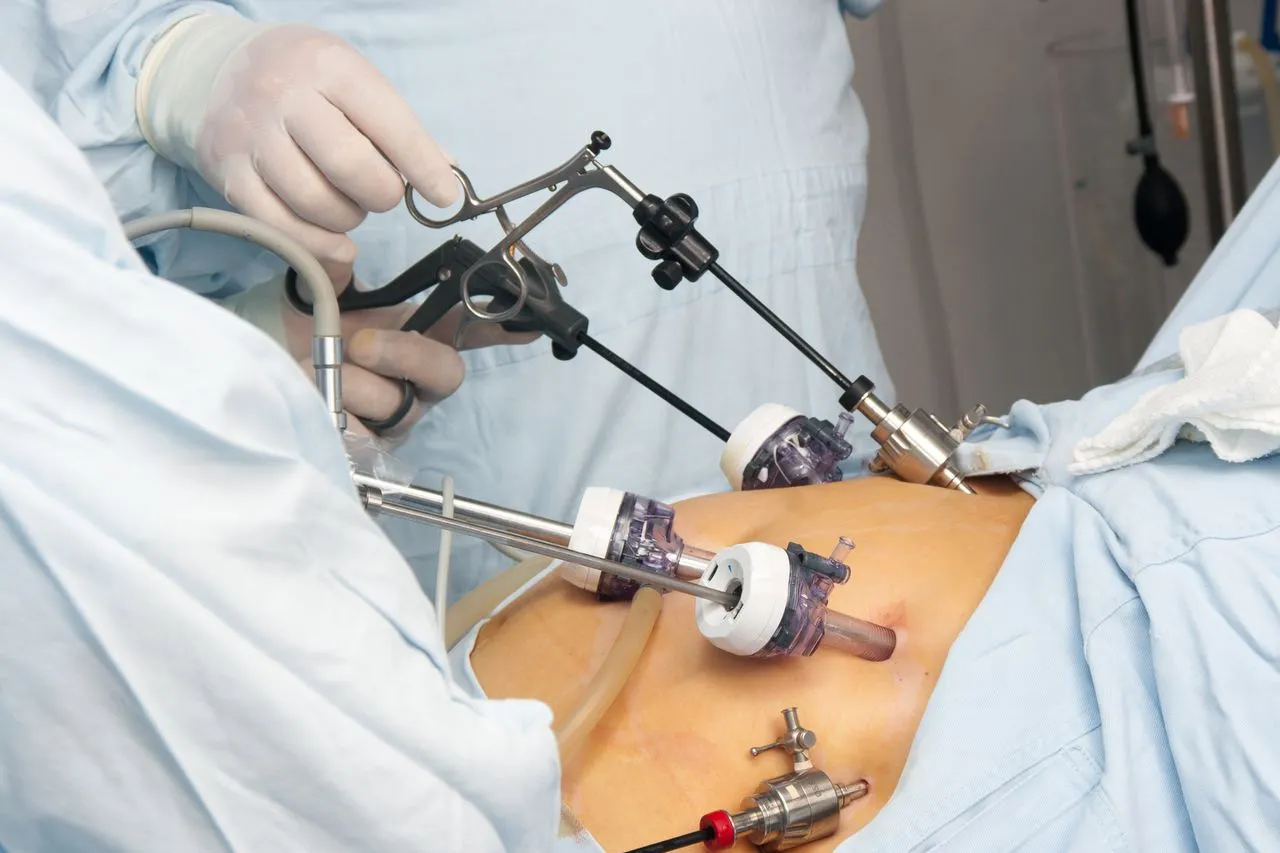gastric sleeve 4