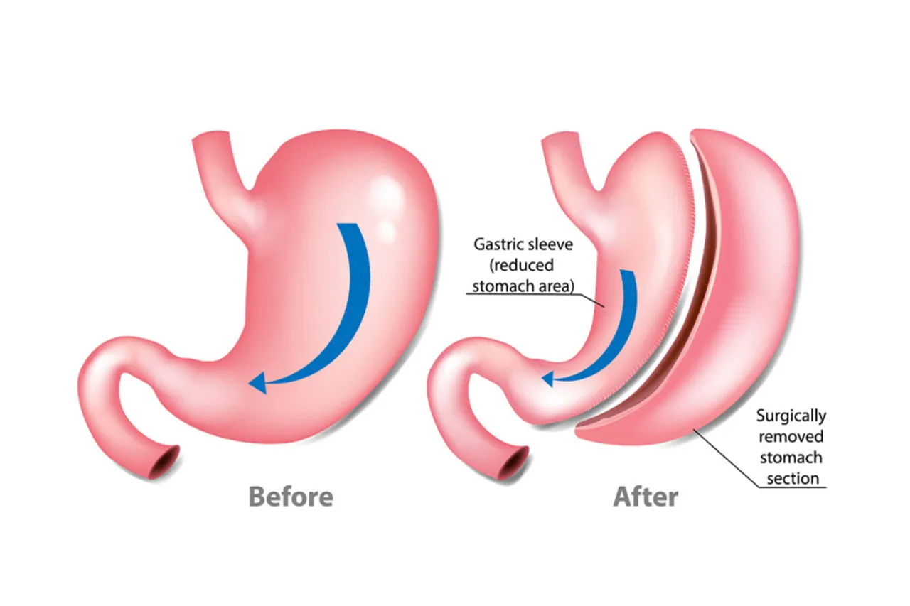 gastric sleeve 5