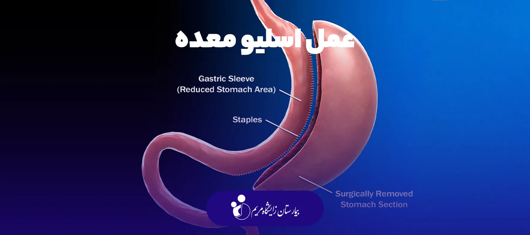 gastric sleeve