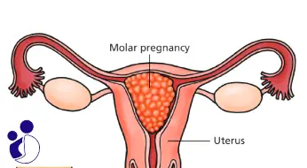 بارداری مولار