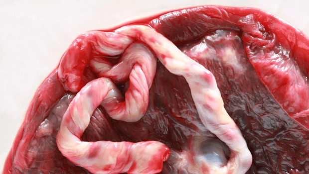 انواع جدا شدن جفت از جنین