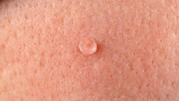 از کجا بفهمیم زگیل تناسلی داریم