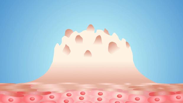 شکل زگیل تناسلی در زنان