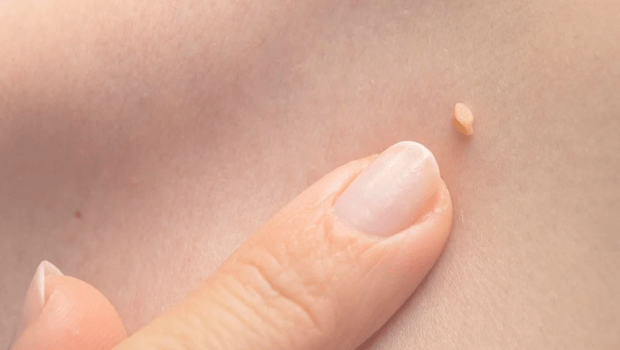 شکل زگیل تناسلی