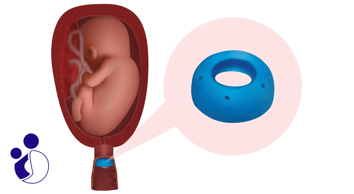 پساری برای جلوگیری از زایمان زودرس