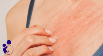 خارش سینه قبل از پریود