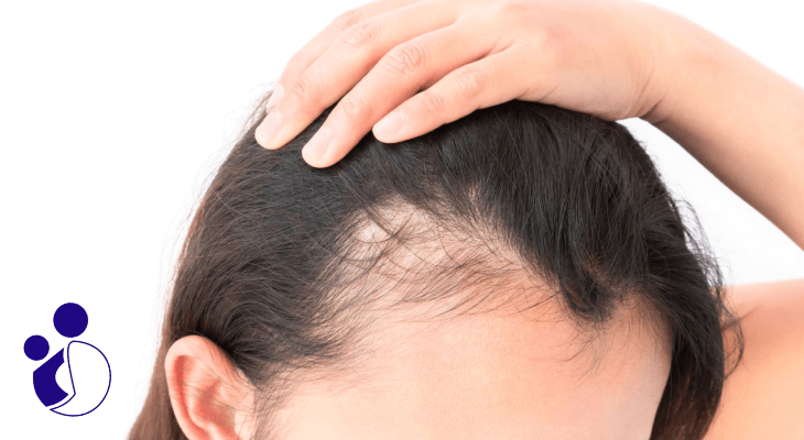 علت ریزش مو در زنان