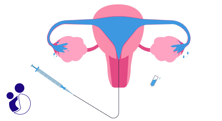 Hysterosalpingography1 1